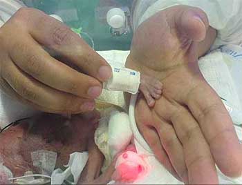 Imagem divulgada por hospital mostra pé da criança pouco depois de nascer: hoje, ela pesa 3,3 quilos (Vanuza da Silva Moreira )