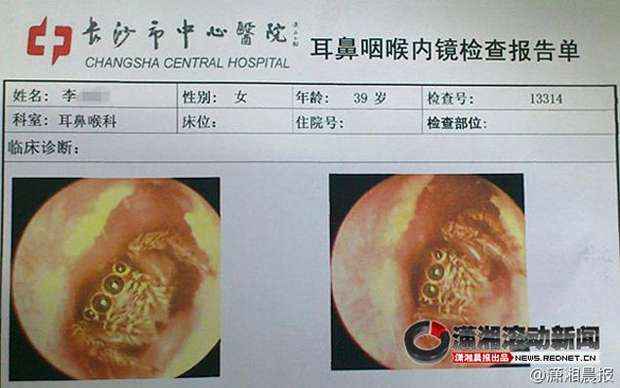 Ficha da paciente mostra imagem da aranha dentro do canal auditivo (Reprodução internet / News.rednet.cn)