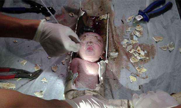 O menino de 2,3 quilos sofreu alguns cortes no rosto, pernas e braços (AFPTV / AFP)