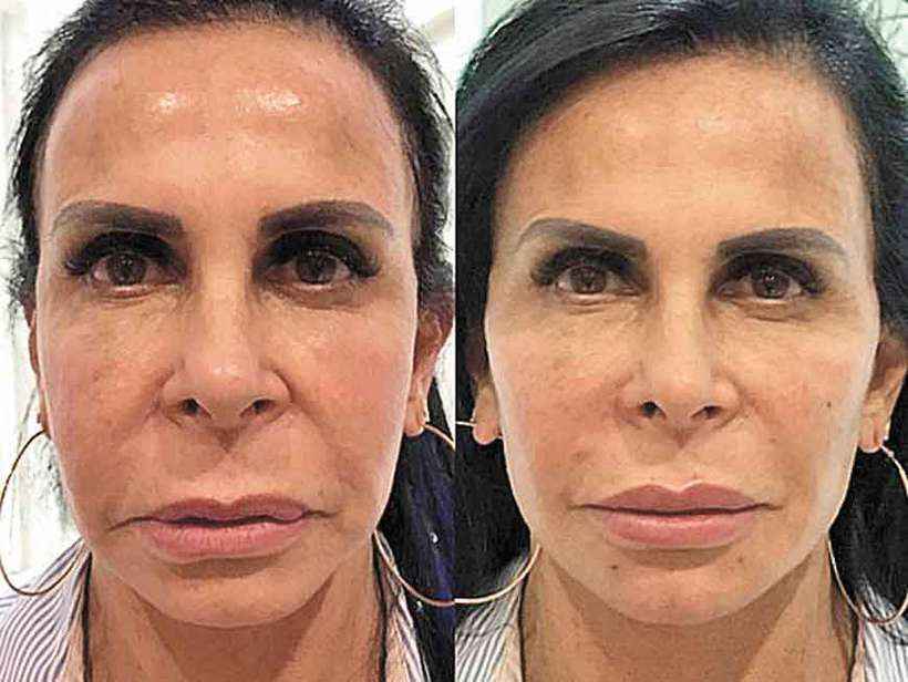 Gretchen e outras celebridades apostam na harmonização facial - Saúde