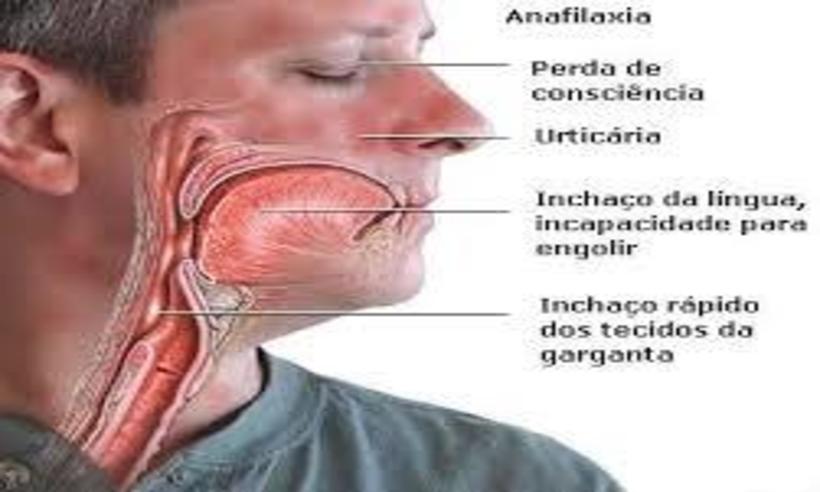 Entenda O Que Anafilaxia Rea O Al Rgica Que Pode Levar Morte Em