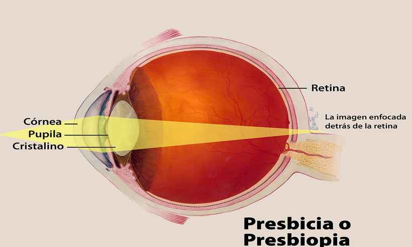Presbiopia: O que é e por que temos esse problema na visão?