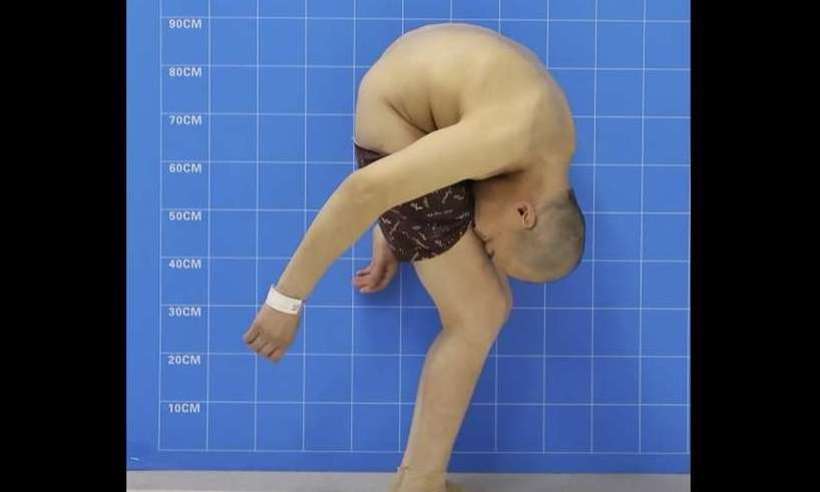 Cirurgia 'conserta' coluna de chinês que vivia com 'rosto nas coxas'