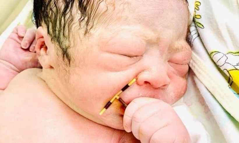 Bebê nasce junto com um DIU e surpreende o obstetra