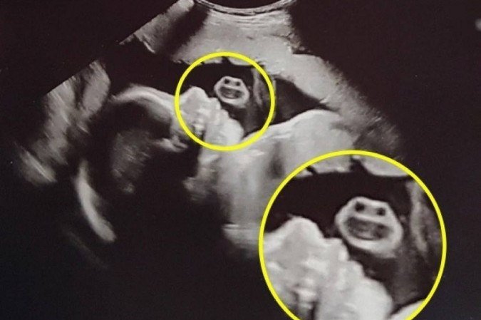 'Tartaruga ninja? Imagem de ultrassom na barriga da mãe viraliza nas redes